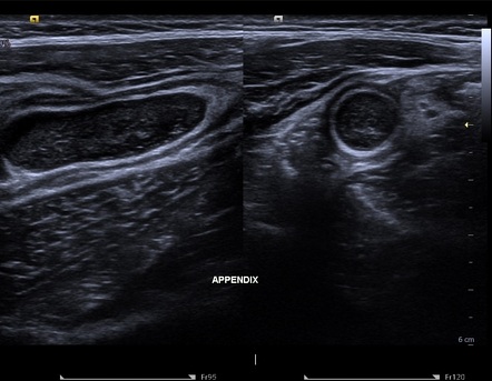 Acute Appendicitis | Radiology Case | Radiopaedia.org