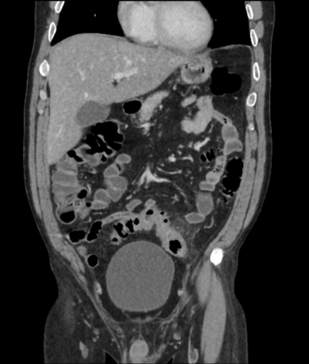 Perforated sigmoid diverticulitis | Image | Radiopaedia.org