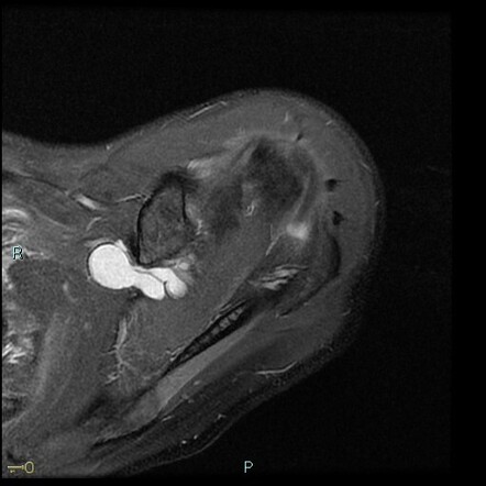 Suprascapular and spinoglenoid large paralabral notch cyst with ...