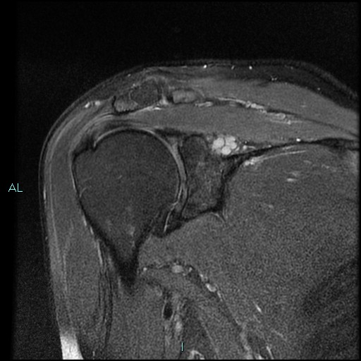 Suprascapular And Spinoglenoid Large Paralabral Notch Cyst With 