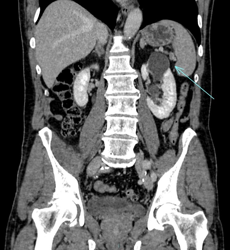 Calyceal Diverticulum Image