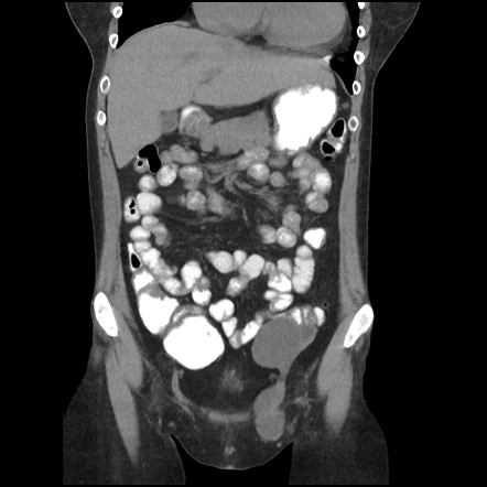 Canal Of Nuck Hydrocele | Radiology Case | Radiopaedia.org