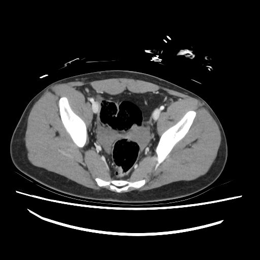 Mesenteric avulsion | Image | Radiopaedia.org