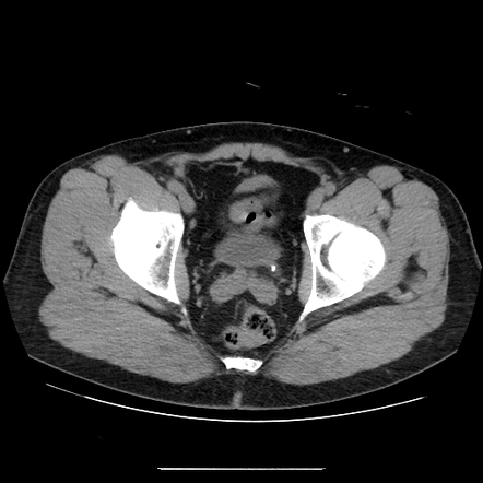 Ureterovesicle junction stone | Radiology Case | Radiopaedia.org