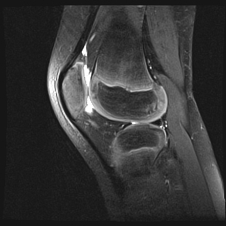 Normal femoral ossification | Image | Radiopaedia.org