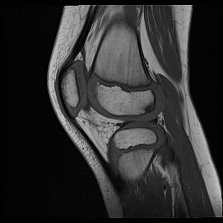 Normal Femoral Ossification 