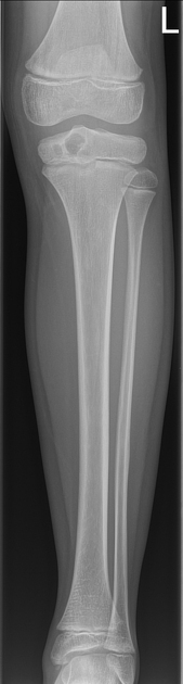 Brodie s abscess epiphyseal Radiology Case Radiopaedia