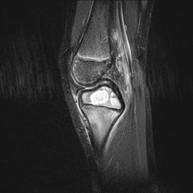 Brodie s abscess epiphyseal Radiology Case Radiopaedia