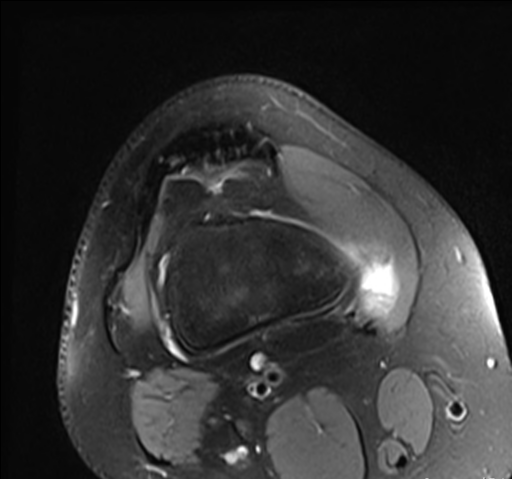 Adventitial bursitis secondary to a distal femoral osteochondroma ...