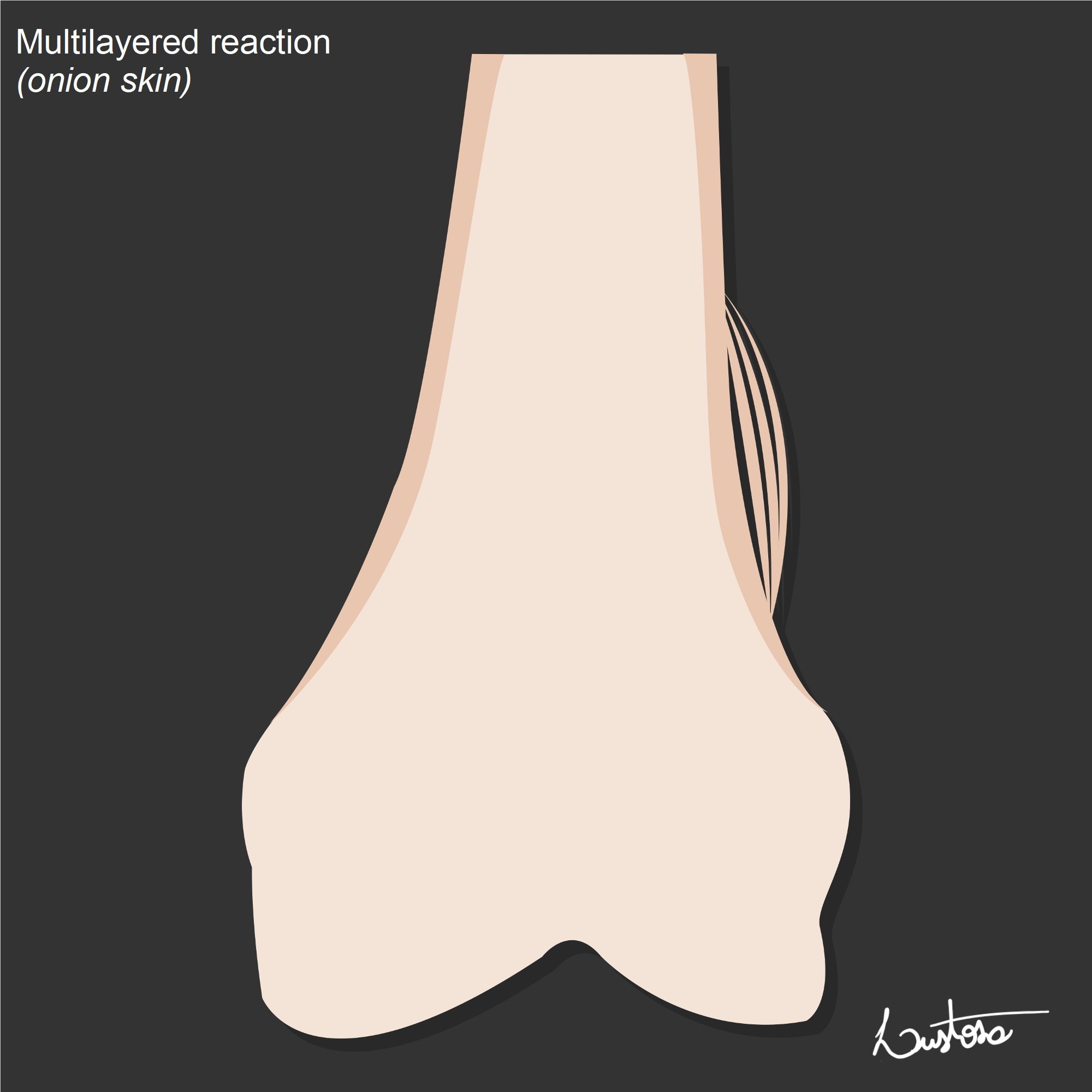 Periosteal reaction types | Image | Radiopaedia.org