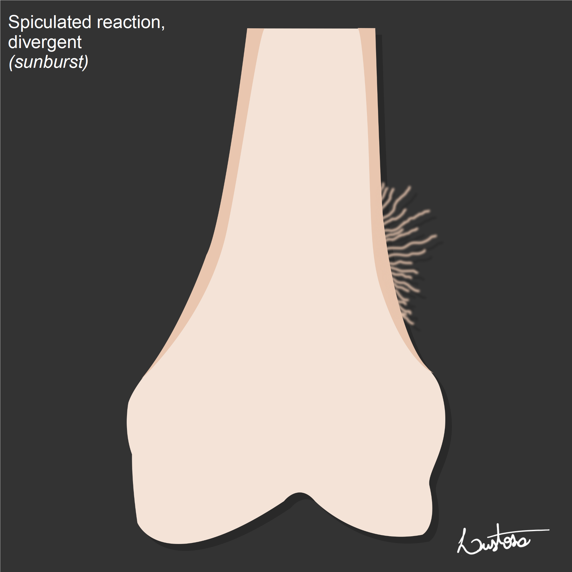 Periosteal reaction types | Image | Radiopaedia.org