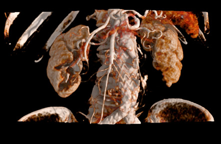 Endoleak: type Ia (dynamic CT) | Radiology Case | Radiopaedia.org