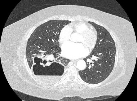 Lung abscess | Radiology Case | Radiopaedia.org