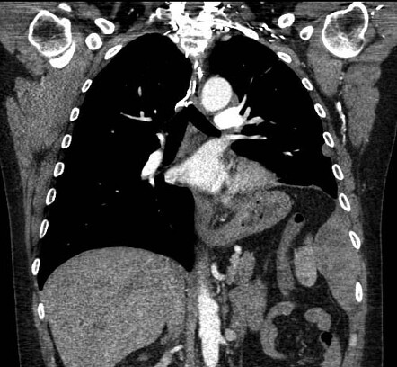 Phrenic nerve palsy | Radiology Reference Article | Radiopaedia.org