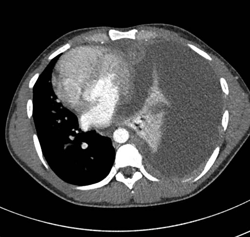 Lymphoma with pleural involvement | Image | Radiopaedia.org