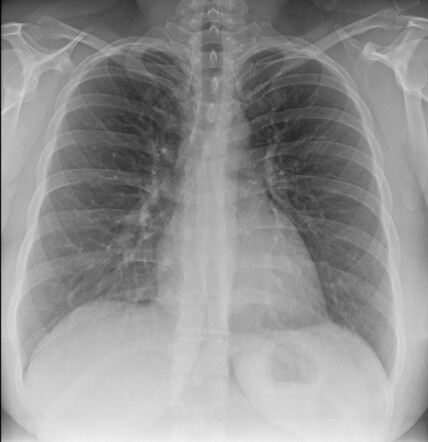 Normal hemithorax | Image | Radiopaedia.org