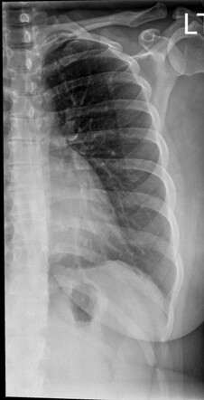 Normal hemithorax | Radiology Case | Radiopaedia.org