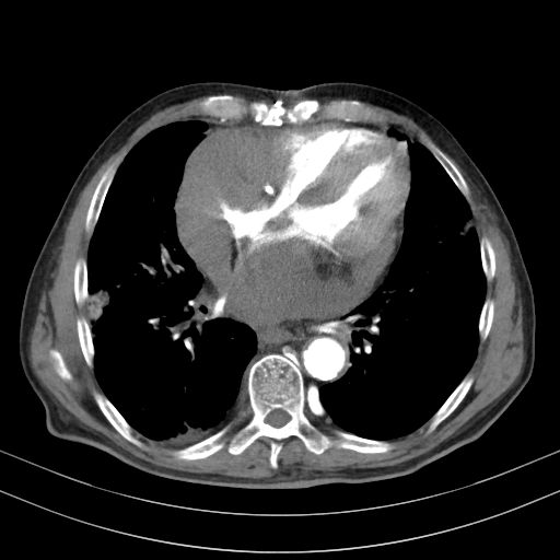 Cardiac tamponade | Image | Radiopaedia.org