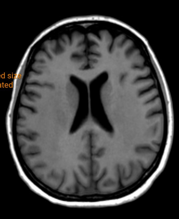 Diffuse Anoxic Brain Injury Post Cardiac Arrest | Image | Radiopaedia.org