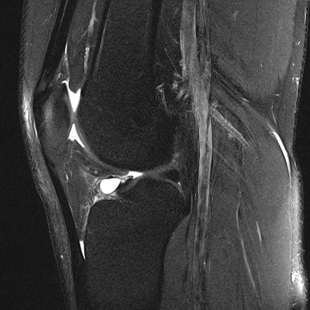 Anterior lateral parameniscal cyst | Radiology Case | Radiopaedia.org