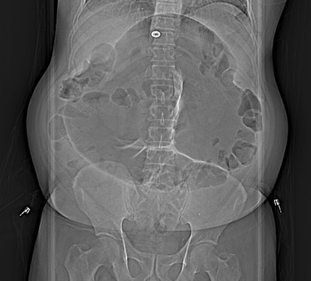 Omental Torsion With Sigmoid Colon Closed Loop Obstruction Radiology Case Radiopaedia Org