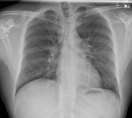 Pulmonary sarcoidosis | Radiology Case | Radiopaedia.org