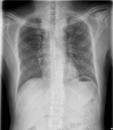 Tuberculous spondylitis | Radiology Case | Radiopaedia.org