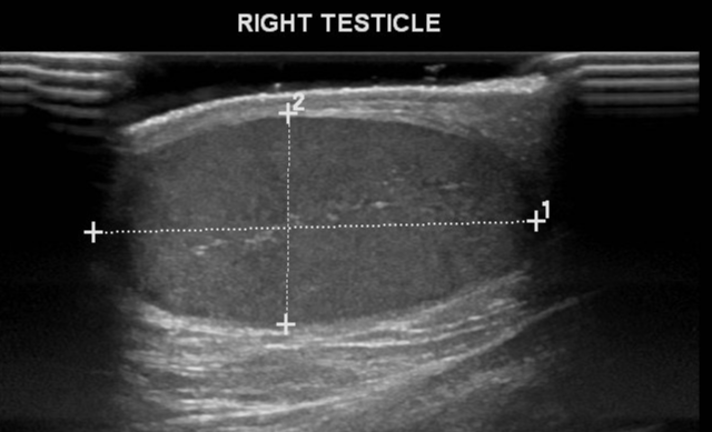 Torsion Of Morgagni Appendix Image