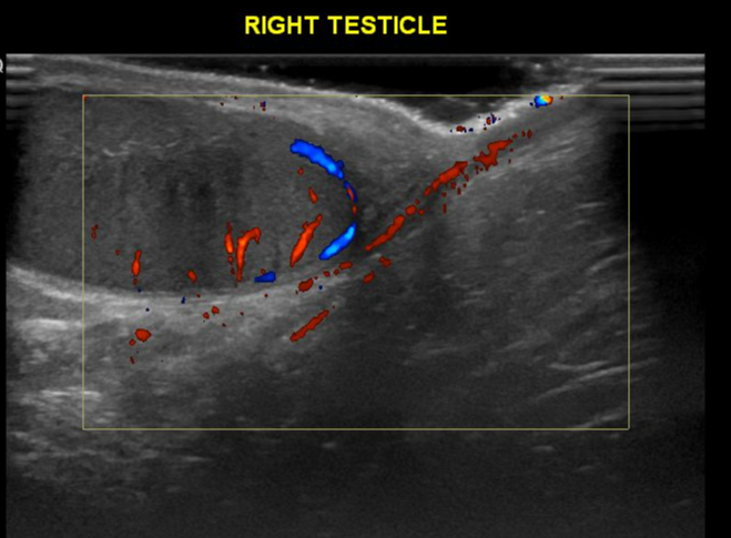 Torsion Of Morgagni Appendix Image