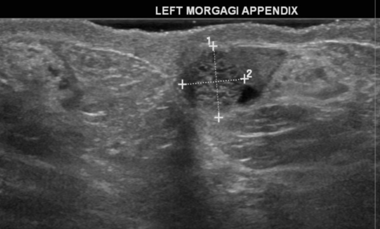 Torsion Of Morgagni Appendix Image