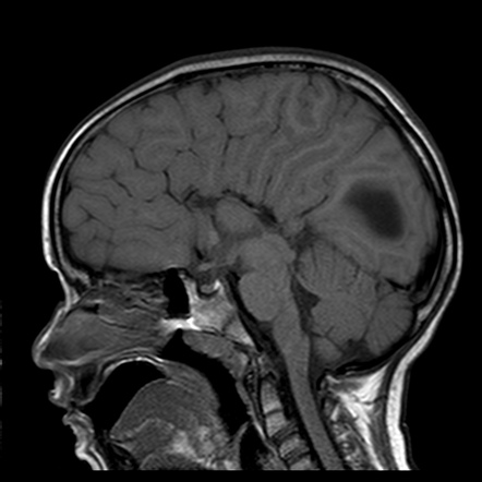 Dysgenesis of the corpus callosum | Radiology Reference Article ...