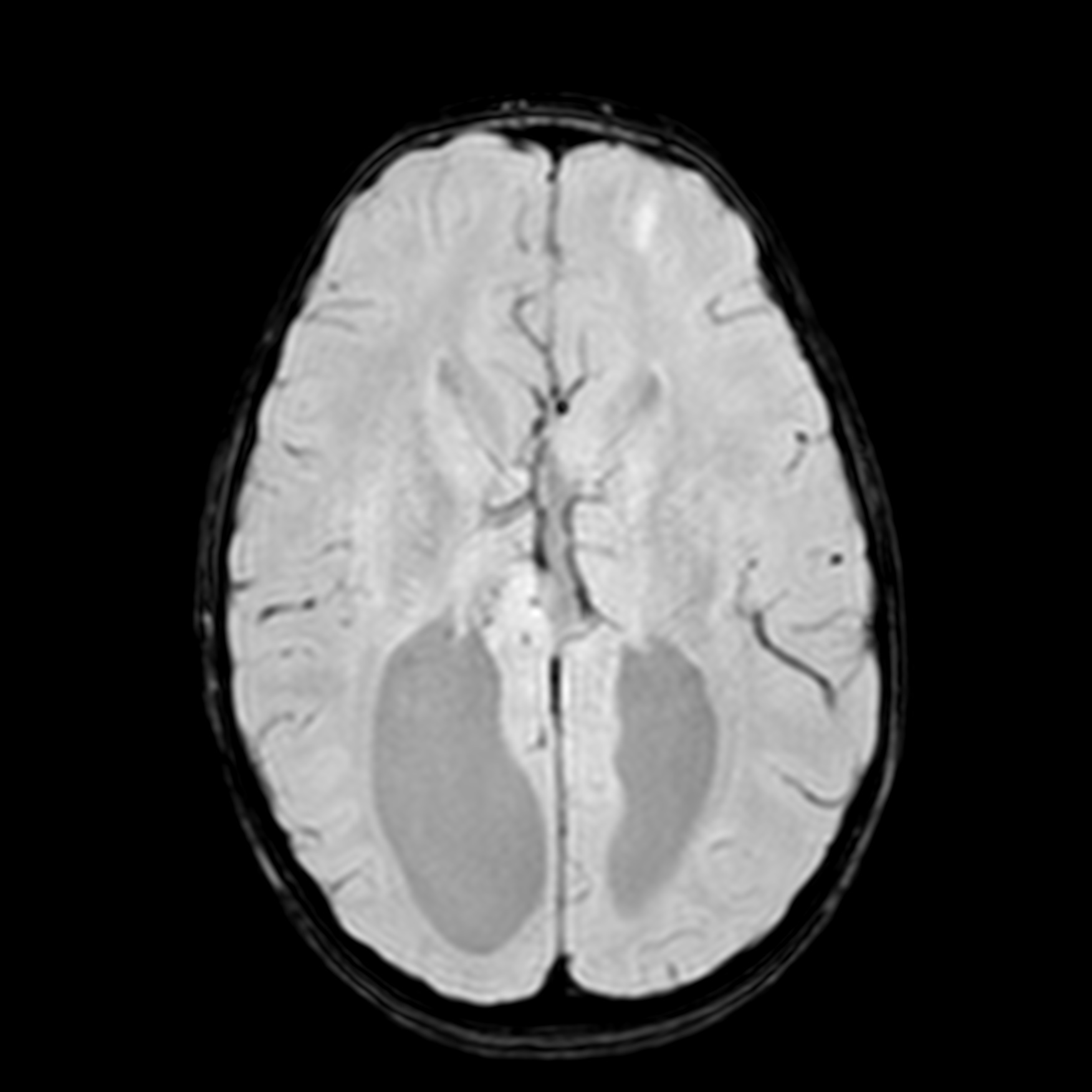 Agenesis of the corpus callosum | Image | Radiopaedia.org