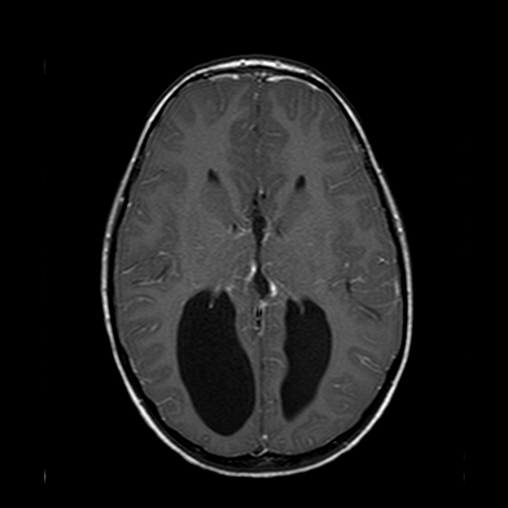 Agenesis of the corpus callosum | Image | Radiopaedia.org