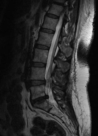 Intraspinal synovial cyst | Radiology Case | Radiopaedia.org