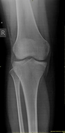 Tibial plateau fracture : Schatzker type V | Radiology Case ...