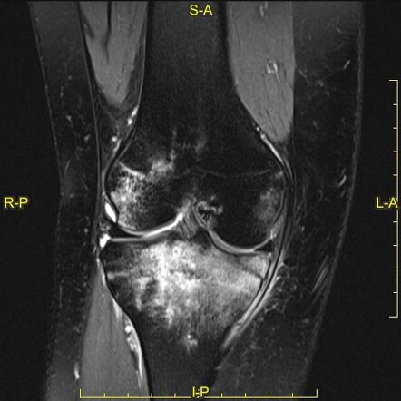 Tibial plateau fracture : Schatzker type V | Image | Radiopaedia.org