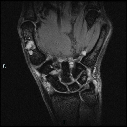 Periosteal chondroma | Radiology Case | Radiopaedia.org