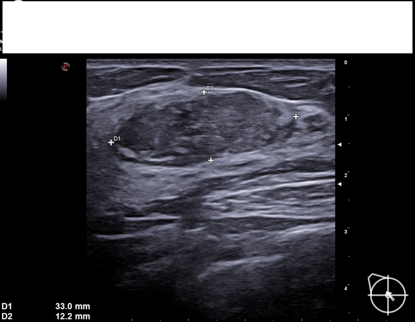 Breast Fibroadenolipoma Image