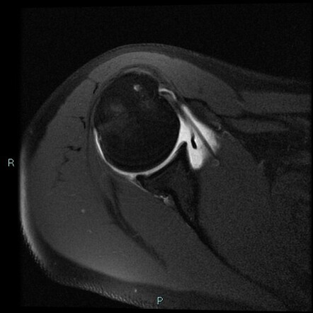 Humeral avulsion of the glenohumeral ligament | Radiology Reference ...