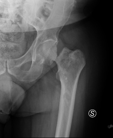 Metastatic chondrosarcoma | Image | Radiopaedia.org