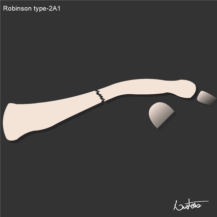 Robinson classification of clavicle fractures | Image | Radiopaedia.org