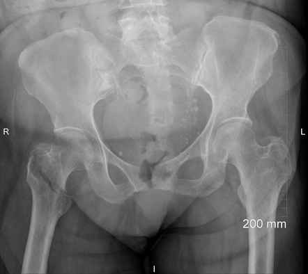 Gamma nail | Radiology Case | Radiopaedia.org