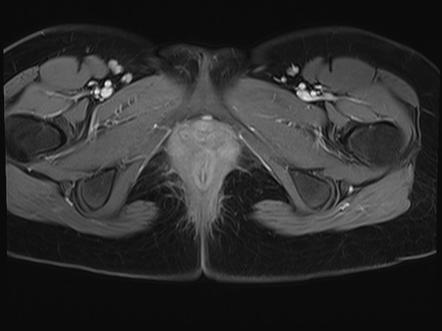 Embryonal rhabdomyosarcoma | Image | Radiopaedia.org