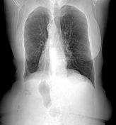 Kartagener syndrome | Radiology Reference Article | Radiopaedia.org