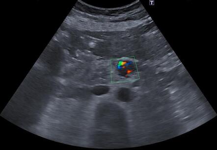 Insulinoma | Radiology Case | Radiopaedia.org