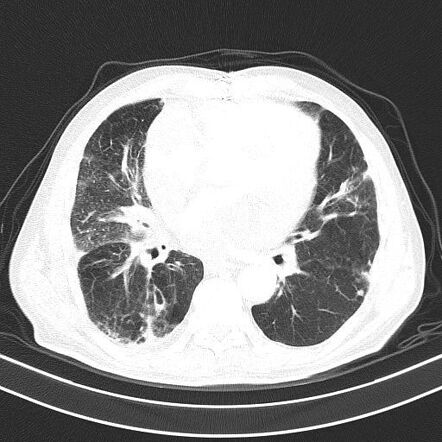 Cardiac tamponade | Image | Radiopaedia.org