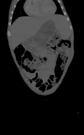 Xanthogranulomatous Pyelonephritis | Image | Radiopaedia.org