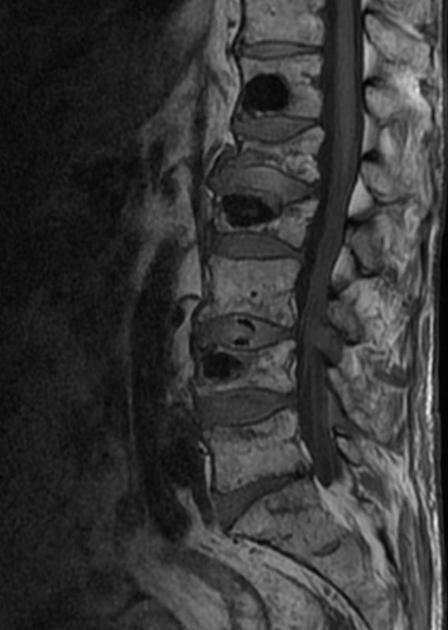 Resolving Compression Fractures with Kyphoplasty