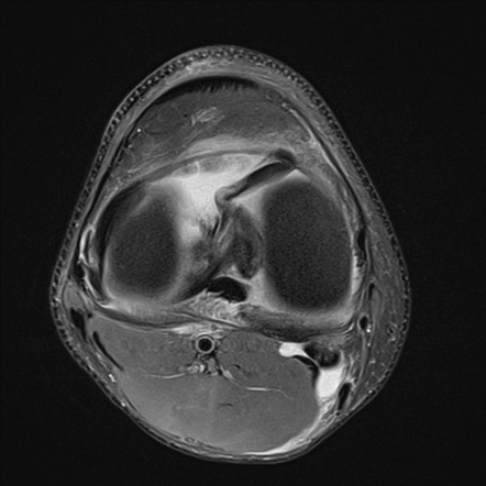 Medial Meniscus Bucket Handle Tear And Semimembranosus Injury 