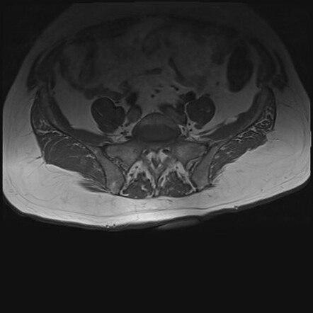 Sacral Chordoma | Image | Radiopaedia.org